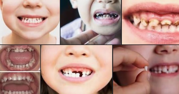 Ağız ve Diş Hastalıkları, Çocukları da Olumsuz Etkiliyor
